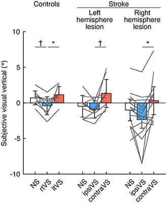 Effects of Galvanic Vestibular Stimulation on Visual Verticality and Standing Posture Differ Based on the Polarity of the Stimulation and Hemispheric Lesion Side in Patients With Stroke